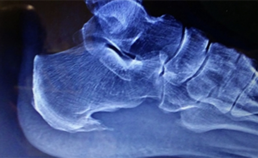 Dr. Timothy Young, a Board-certified Foot Surgeon discusses bone spurs in the foot: Osteophytes