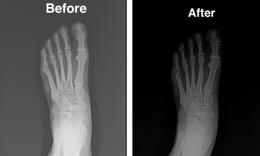 Dr. Timothy Young Talks About Tailor’s Bunion Surgery in Seattle.