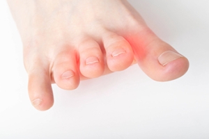 What is Morton’s Neuroma, and How Can Symptoms Be Relieved?