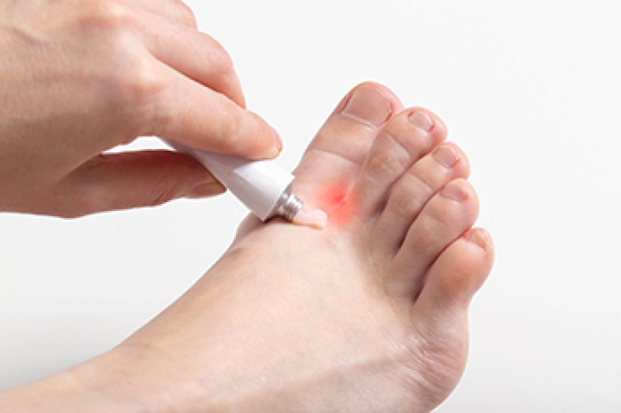 Definition and Symptoms of Athlete’s Foot