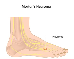 High Heels and Morton’s Neuroma