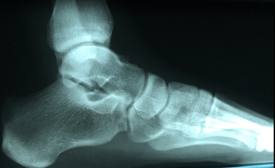 Dr. Brandon Nelson, Board-Certified Foot and Ankle Physician and Surgeon, Discusses Heel pain and Plantar Fasciitis