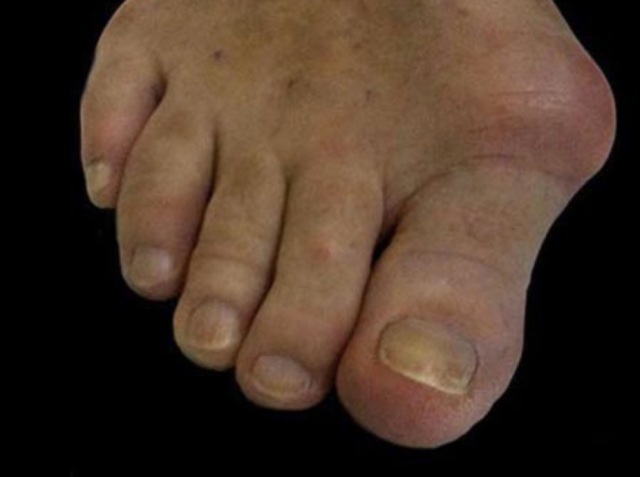 Dr Brandon Nelson, A Board-Certified Physician & Surgeon Discusses Bunion Surgery and How to Recover Faster