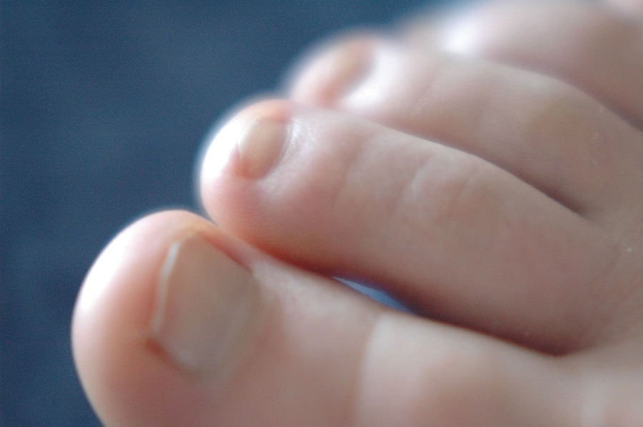 Dr Brandon Nelson, A Double Board-Certified Physician & Surgeon, Discusses Painful Hammertoes