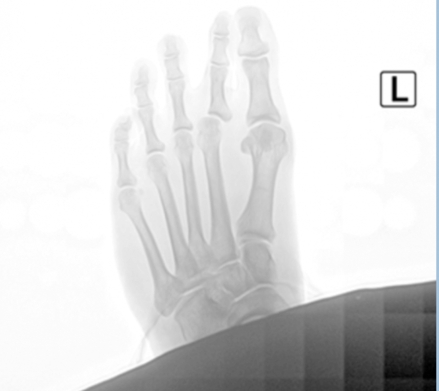 Dr. Timothy Young, a Board-certified Foot Surgeon, Discusses Removing Hardware After Bunion Surgery