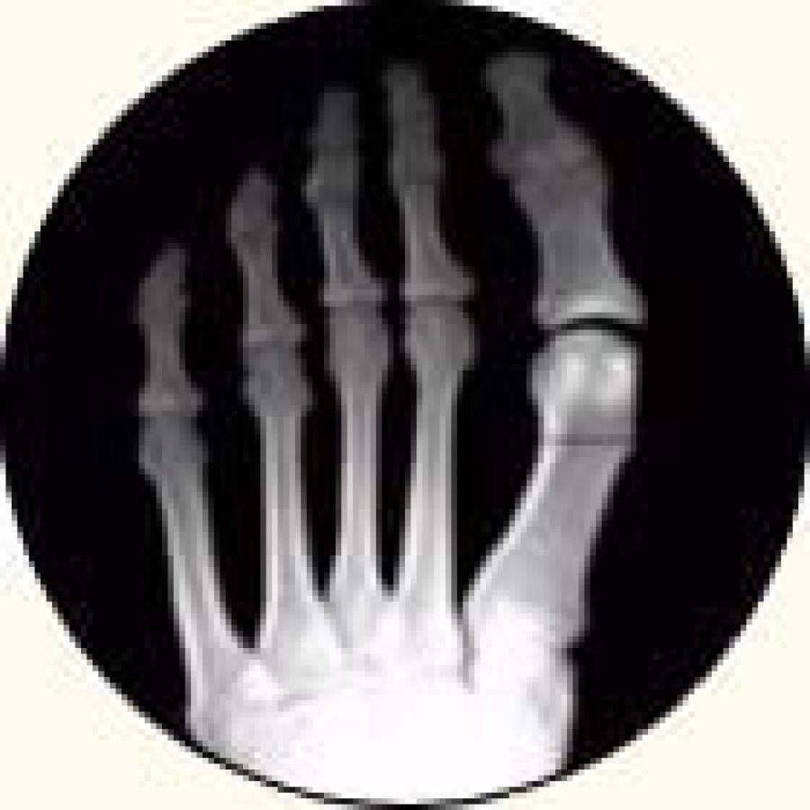 Dr Brandon Nelson, A Board Certified Physician & Surgeon, Discusses When to Get Bunion Surgery