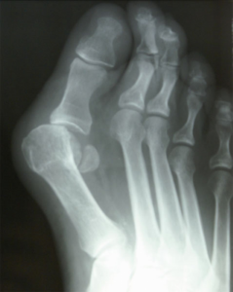Dr. Timothy Young Talks About Bunion Anatomy