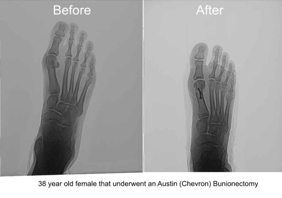 Dr. Brandon Nelson Discusses How to Find The Best Bunion Surgeon