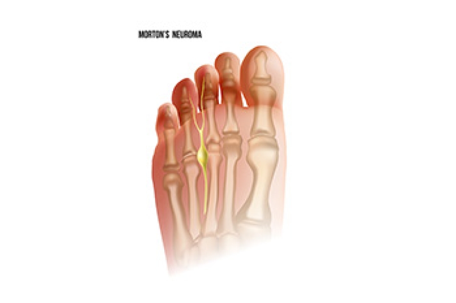 The Truth About Morton's Neuroma