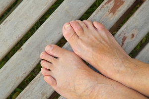 What to Do After Hammertoe Surgery