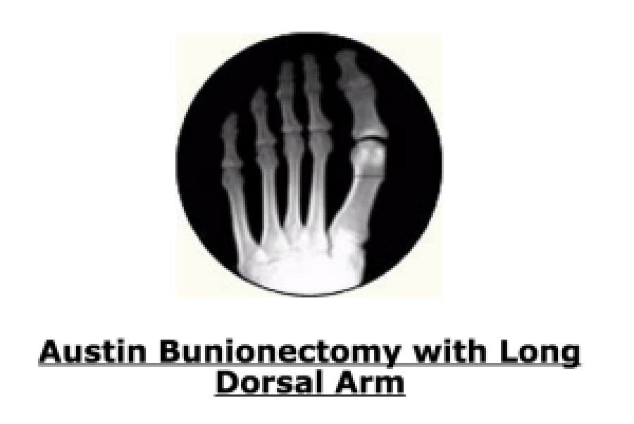 Dr Brandon Nelson, A Board Certified Physician & Surgeon, Discuss the Lapiplasty Bunionectomy