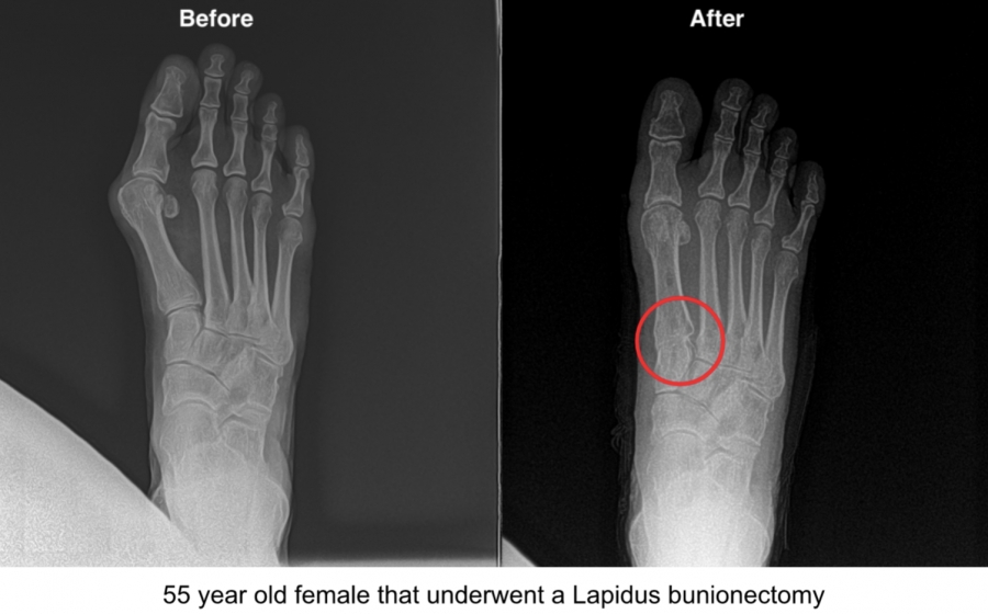 Dr. Timothy Young Talks About Joint Fluid and Bunion Surgery
