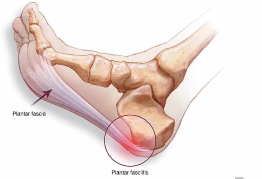 Dr Brandon Nelson, A Board Certified Physician, Discusses Morning Heel Pain