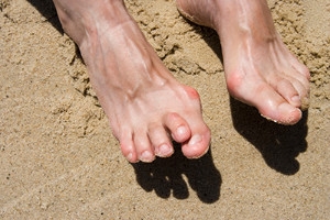 How Hammertoes Affect the Toes