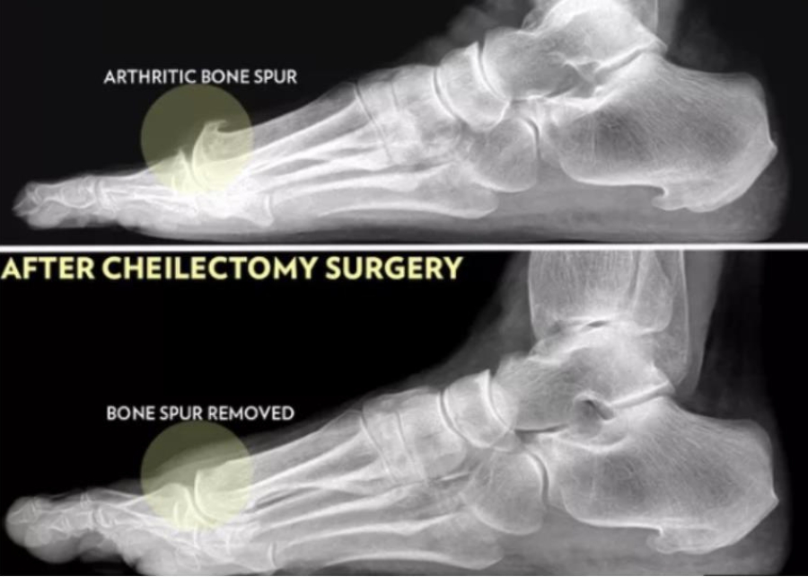 Dr. Timothy Young, Board Certified Foot and Ankle Surgeon, Talks About Hallux Limitus Surgery
