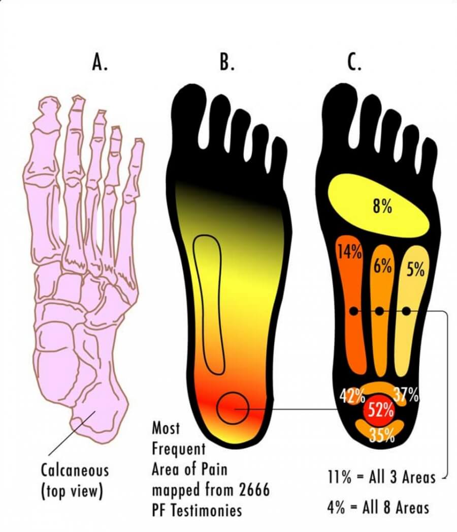 Plantar Fasciitis