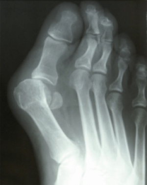 Dr Brandon Nelson, A Board Certified Physician &amp; Surgeon, Discuss Bunion Surgery