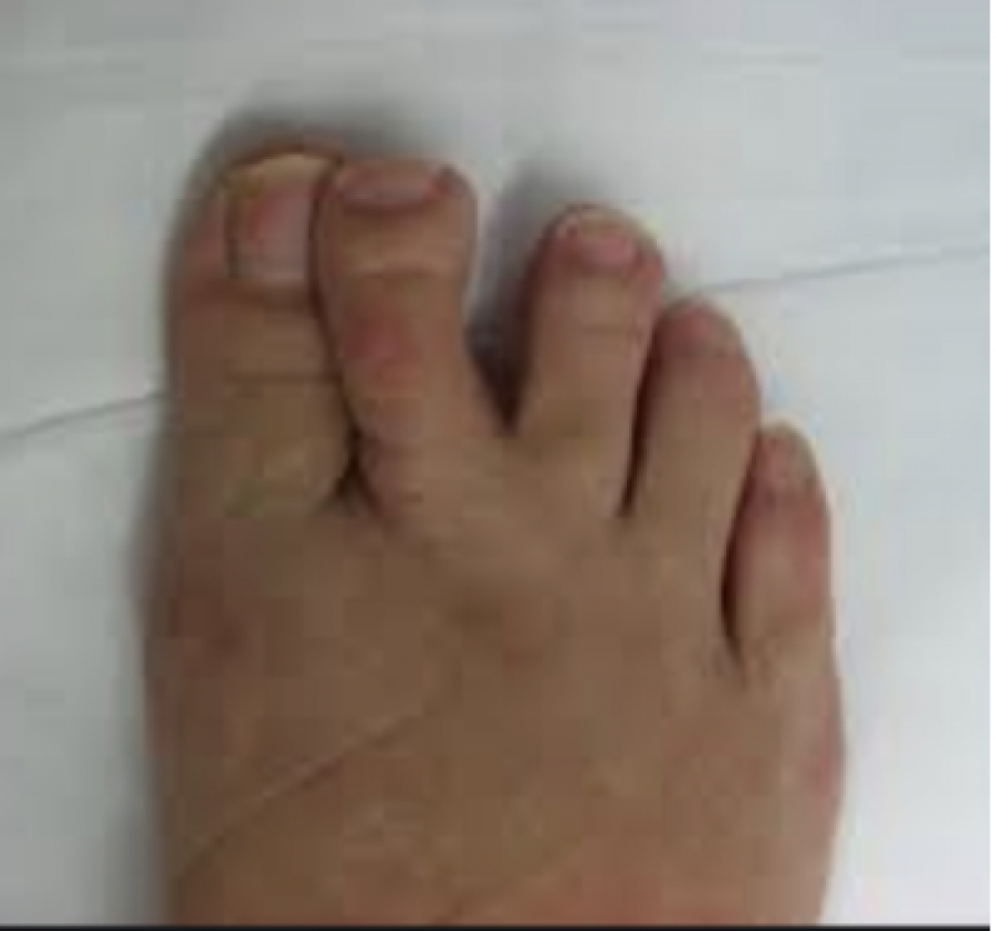 Dr. Timothy Young Talks About Crossover Toe