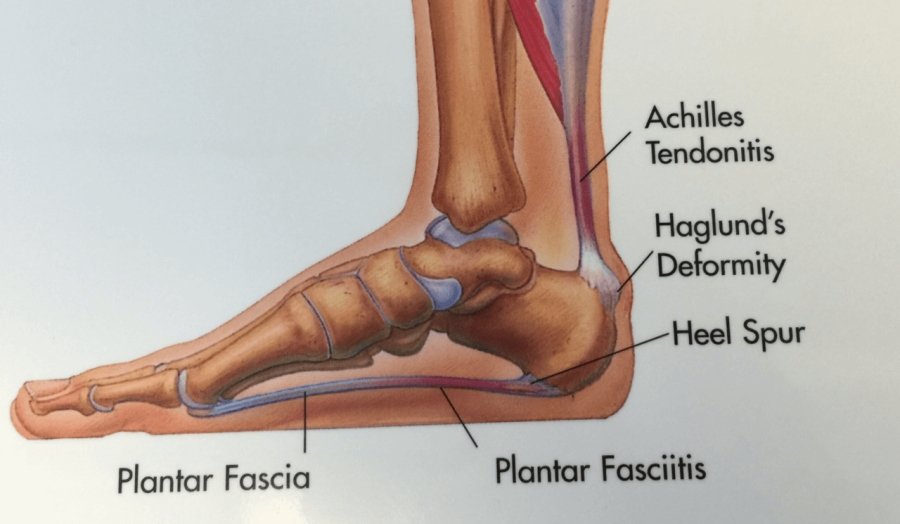 Dr Brandon Nelson, A Board-Certified Physician & Surgeon Discusses Why He Has Been Fixing Heel Pain For Over 15 Years