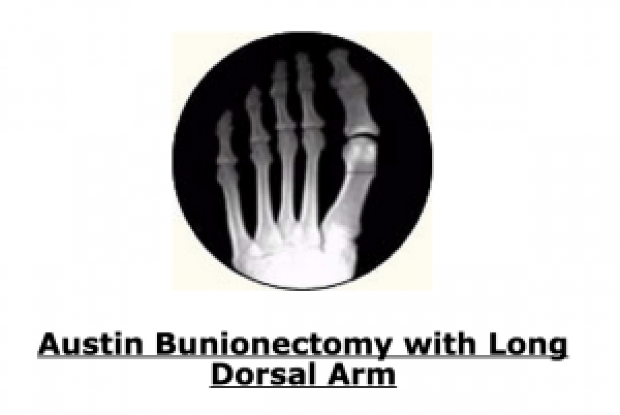 Dr. Brandon Nelson, Board-Certified Foot and Ankle Physician and Surgeon, Discusses Outcomes for Bunion Surgery
