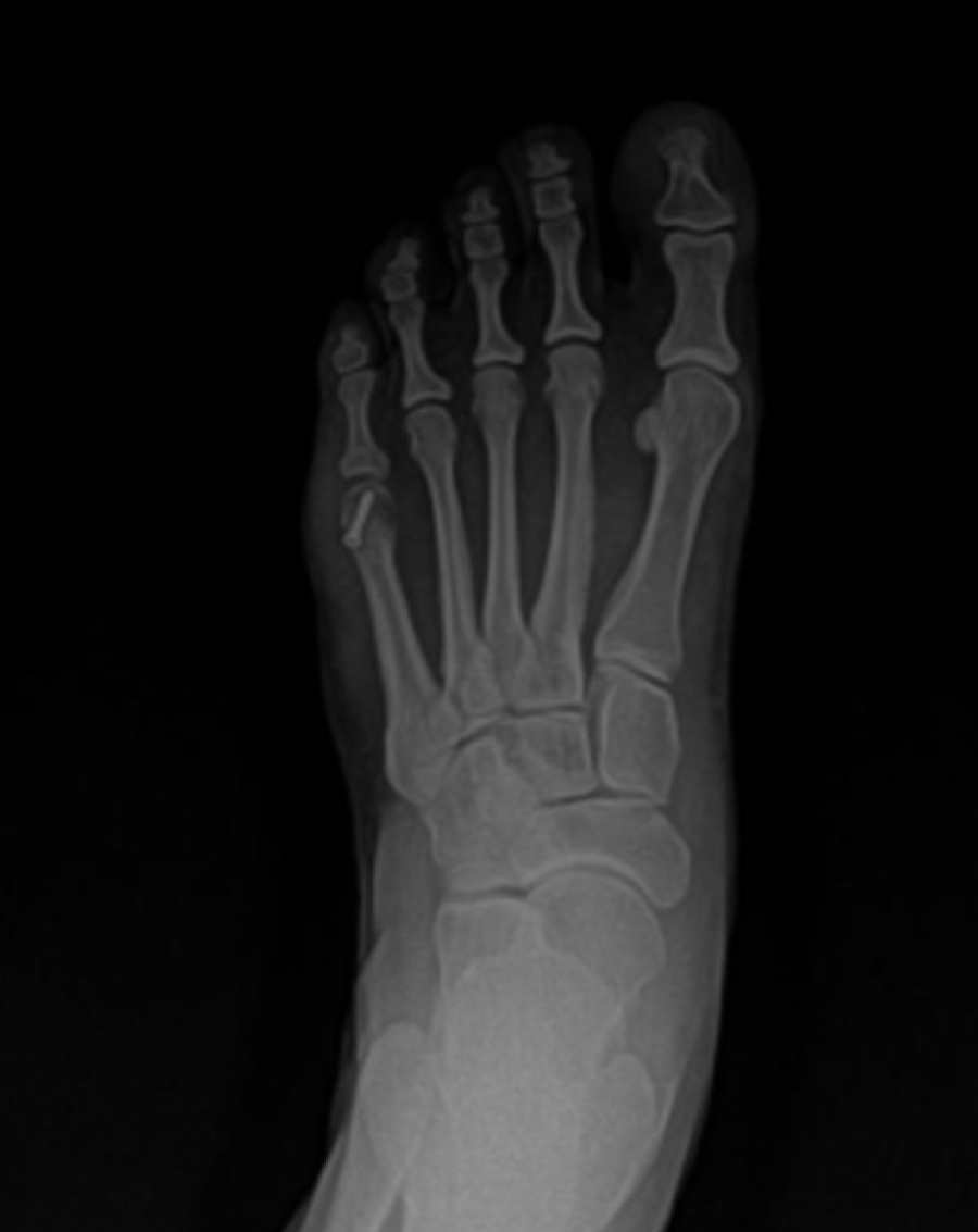 Dr. Timothy Young, a Board-Certified Foot Surgeon, Discusses Removal of Hardware After Foot Surgery